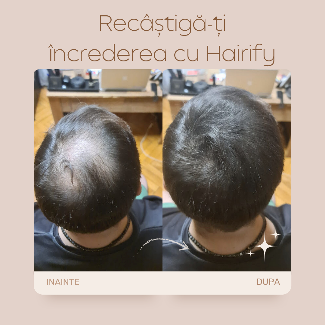 Un om cu chelie si alopecie difuza, before and after Hairify
