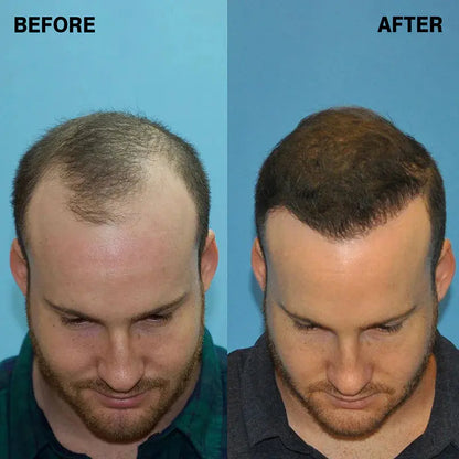 Hairify – Fibre de păr (27.5 Grame - pentru aproximativ 2 luni)